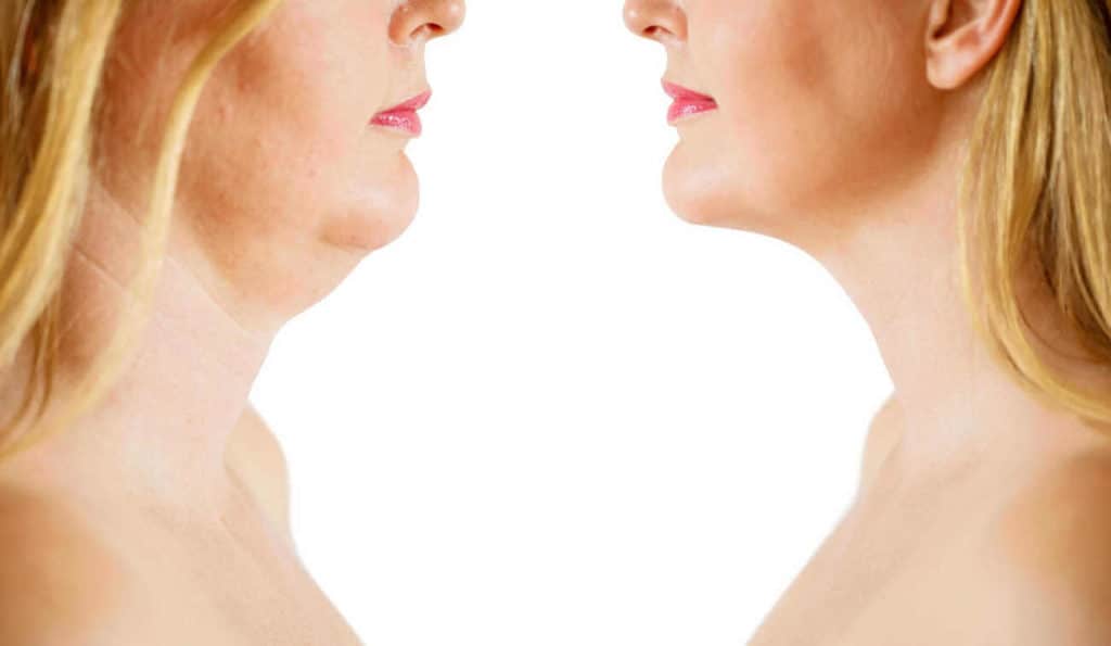 Double Chin treatment Bow before and after results