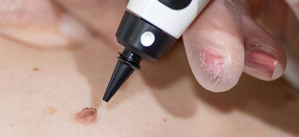 After Skin Tag Removal Bow