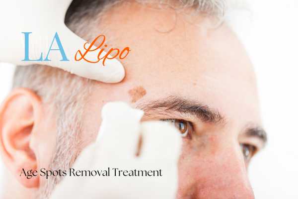 What Are the Most Effective Treatments for Age Spots Bow?