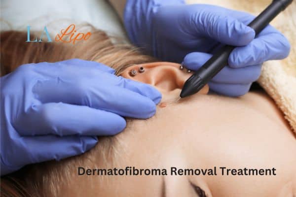 Dermatofibroma Removal Treatment Bow