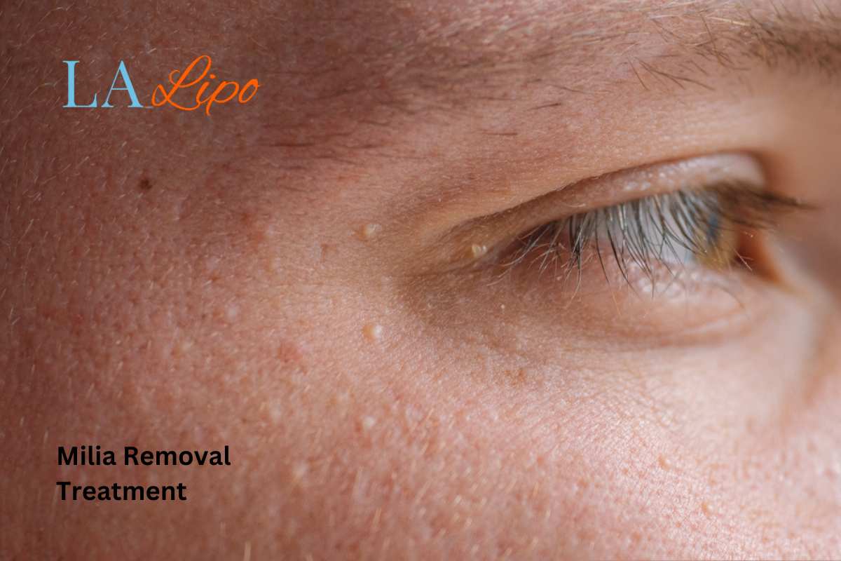 Cryopen Milia Removal: Is It the Easiest and Safest Option Bow?