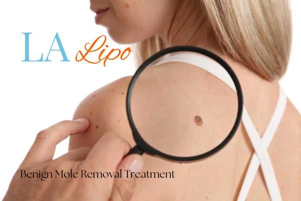 Woman having her inspection of blemish before mole removal Bow