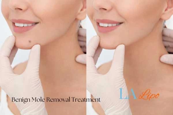 Before and after mole removal Bow treatment