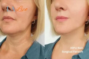 hi-fu for wrinkles Bow before and after results