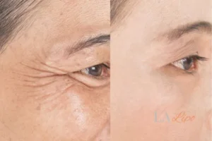 Before and after results of woman - HI-fu wrinkles reduction treatment Bow