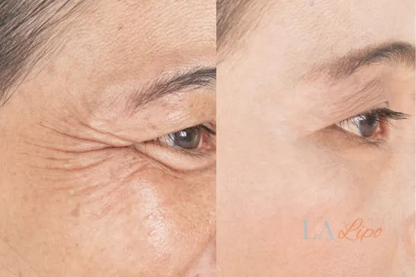 Before and after results of woman - HI-fu wrinkles reduction treatment Bow