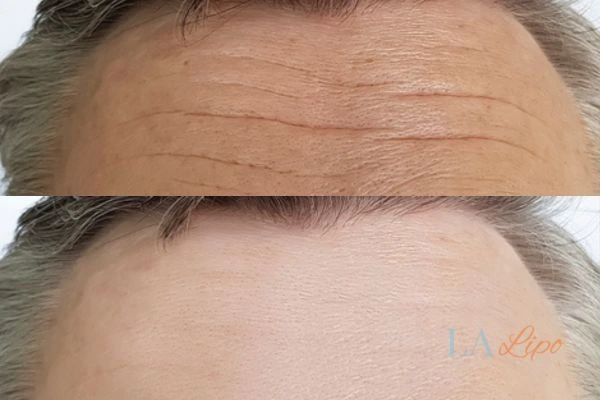 results of HIFU Bow on mans forehead to help reduce lines and wrinkles