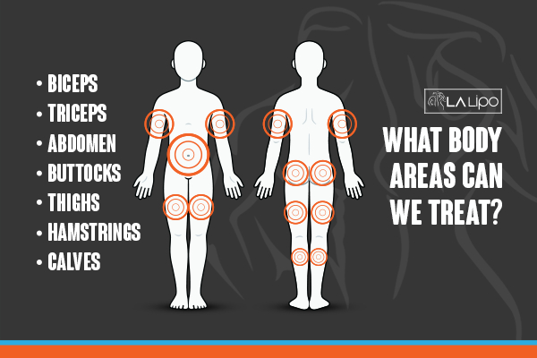 Graphic to show areas you can have LA-EMS Body Sculpting Bow treatment.