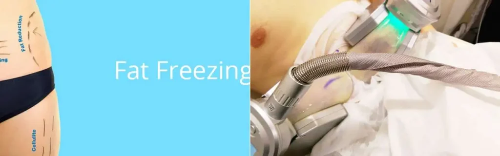 Fat freezing Bow on multiple areas of the body