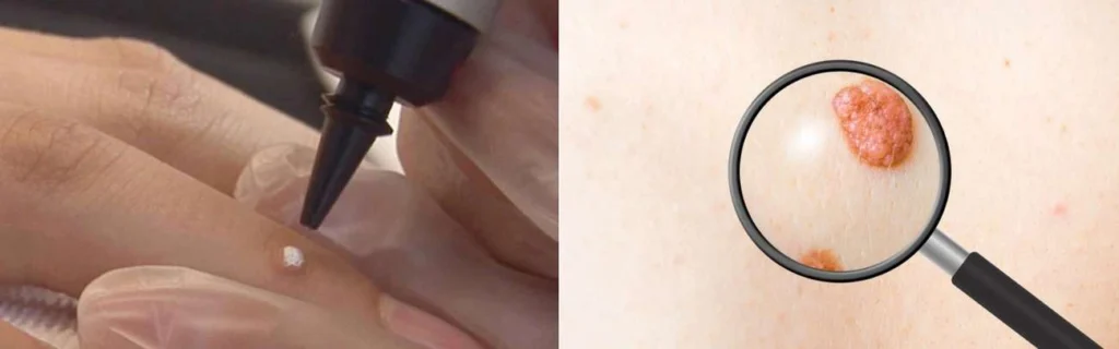 Person getting moles removed with cryopen Bow
