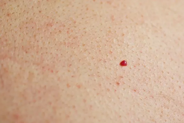 close up of a cherry angioma Bow