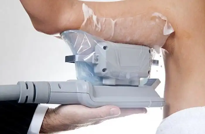 Picture of fat freezing Bow on the upper arms.