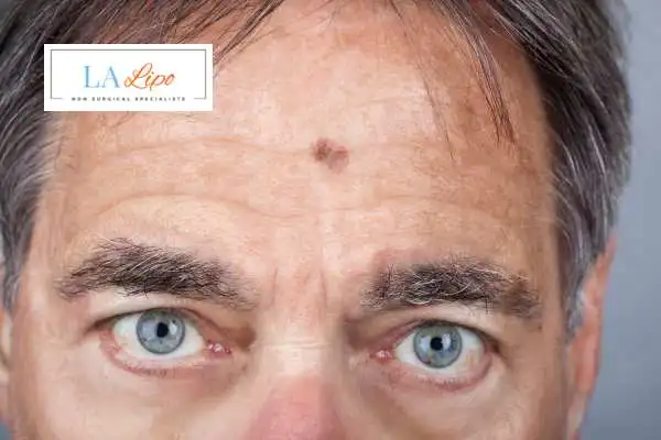 Solar Lentigo Removal Bow image of man with mark on his forehead