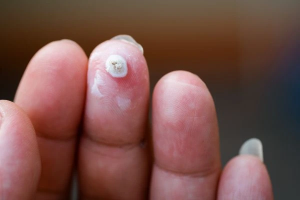 wart on person finger - cryotherapy to treat from LA LIPO Bow
