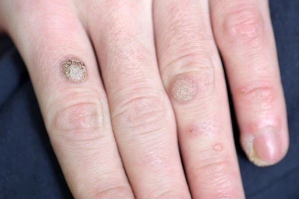 photo of warts on person hand - see wart removal Bow from LA LIPO