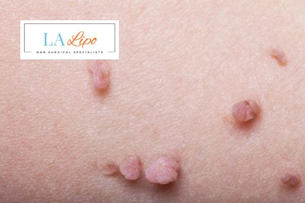 Does cryopen skin tag removal Bow hurt? Find out now call our team today!