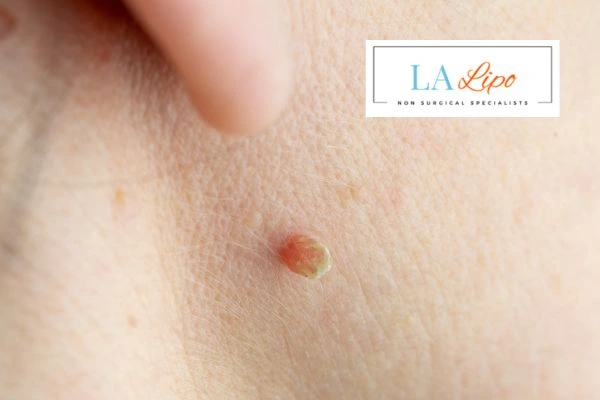 Book skin tag removal Bow today speak to our team now!