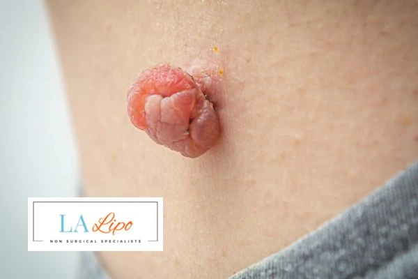 Interested in skin tag removal Bow? Concerned about the pain? Find out more today!