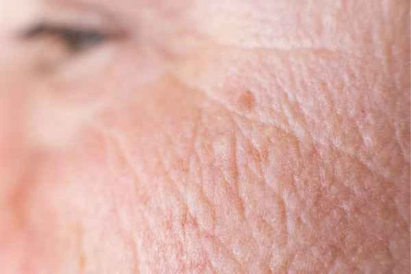 close up picture of a woman's face showing an age spot Bow