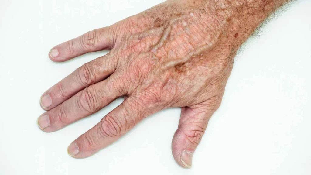 Male hand showing age spot Bow
