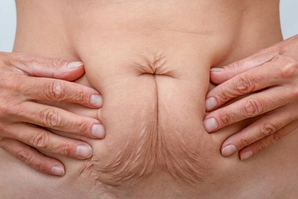 Image of a woman's stomach with loose skin - example of skin tightening Bow options