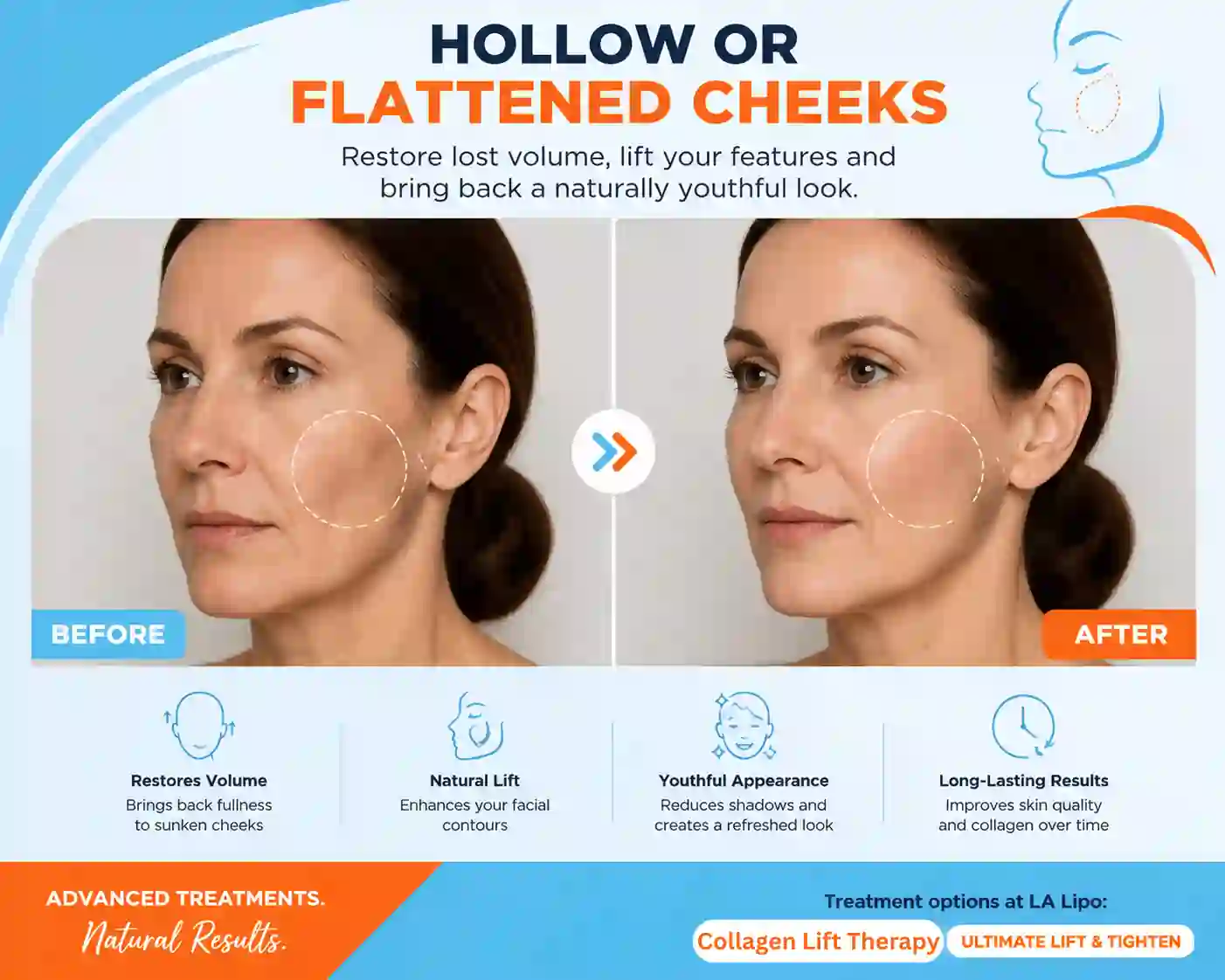 Sign #4: Hollow or Flattened Cheeks Bow
